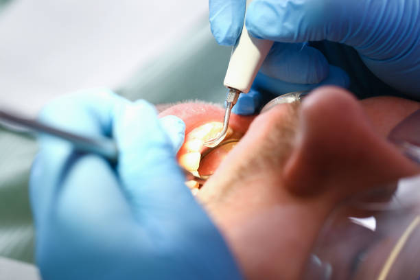 Best Emergency Tooth Extraction in Wyldwood, TX